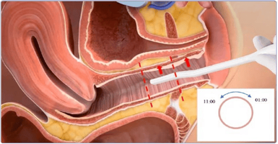 Радиочастотная терапия в гинекологии: что говорит наука